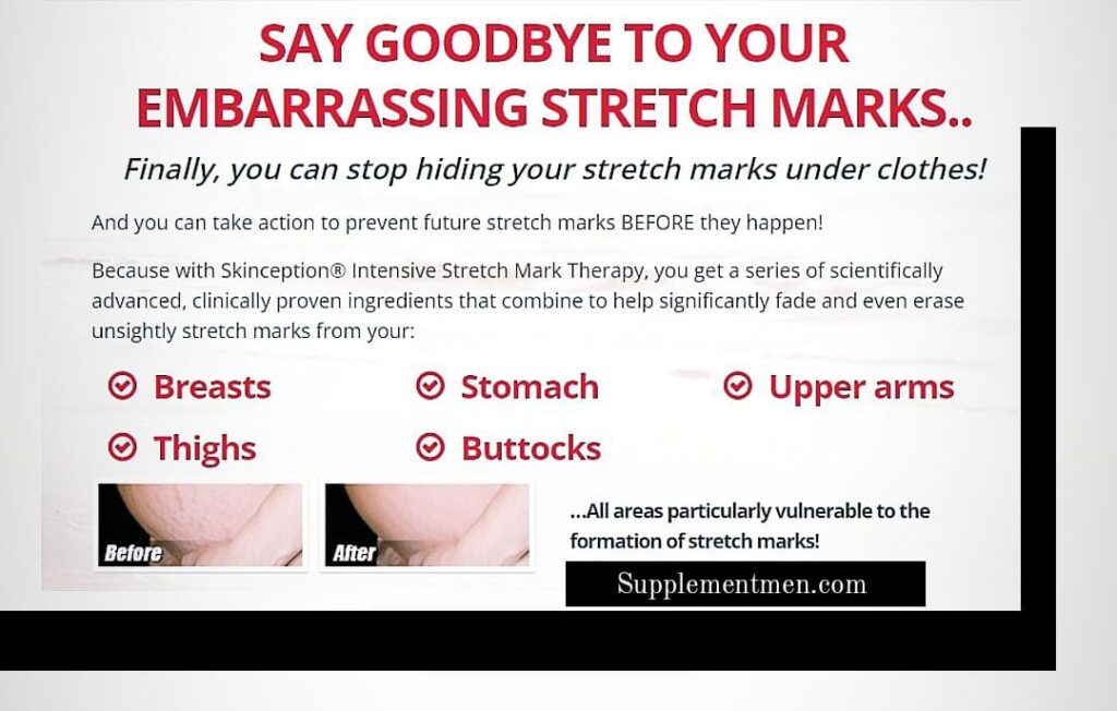 most effective stretch mark removal